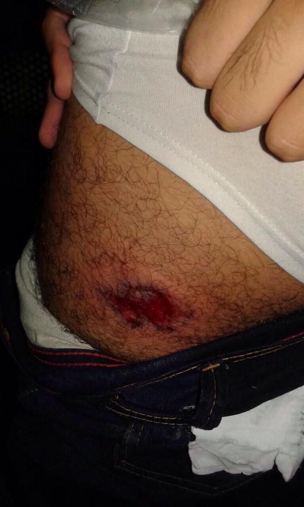 Ferido: repórter do Estado de S. Paulo foi atingido por bala de borracha Ferido: repórter do Estado de S. Paulo foi atingido por bala de borracha