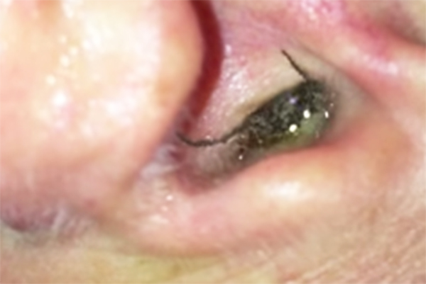 Artista mostra “aranha” vivendo em seu ouvido e viraliza na internet