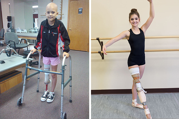 Aos 15 anos de idade, sobrevivente que perdeu uma perna para o câncer volta às aulas de dança