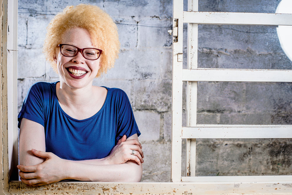 Programa inédito no país ajuda albinos a tratarem da saúde