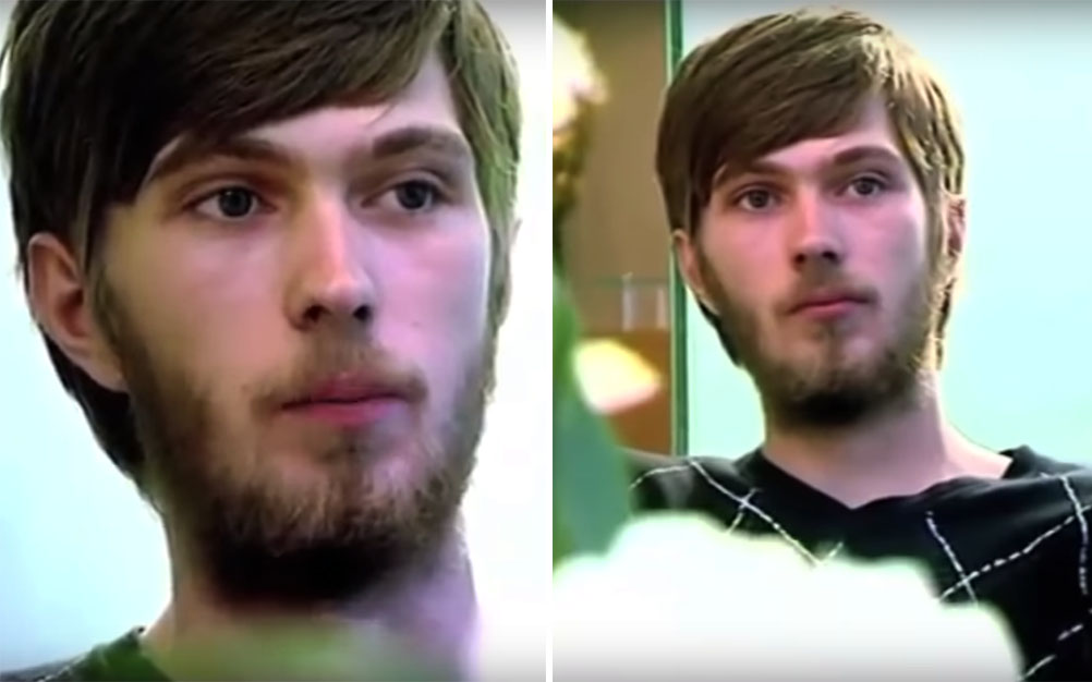 Após 20 anos sem escovar os dentes, jovem precisa fazer implantes