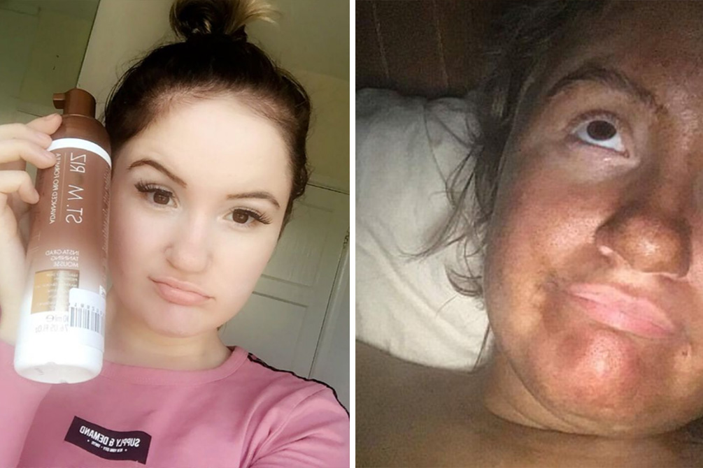 mulher-acidente-autobronzeador-03