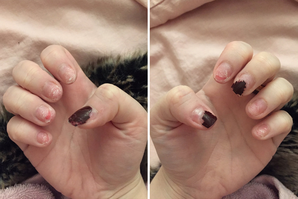 unhas-acrilico-perigo-01