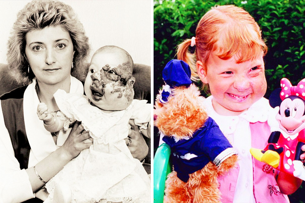 Jovem que nasceu com deformidade no rosto relata “final feliz”