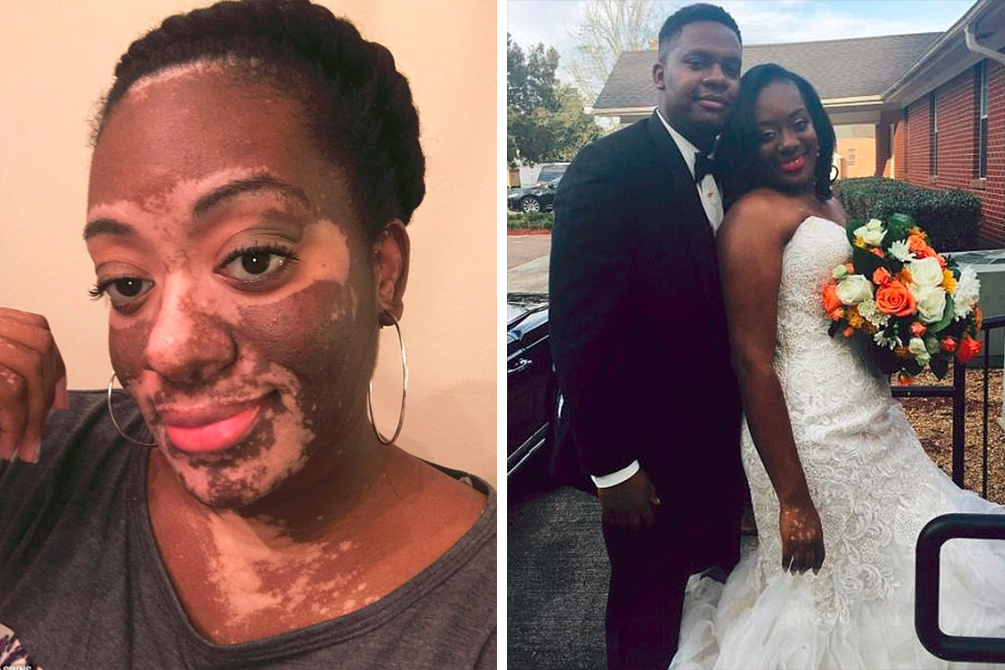 Após estresse, noiva desenvolve vitiligo meses antes do casamento
