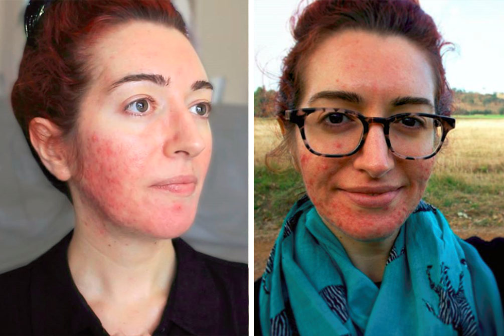 Mulher que luta contra a acne há 15 anos mostra “antes e depois”