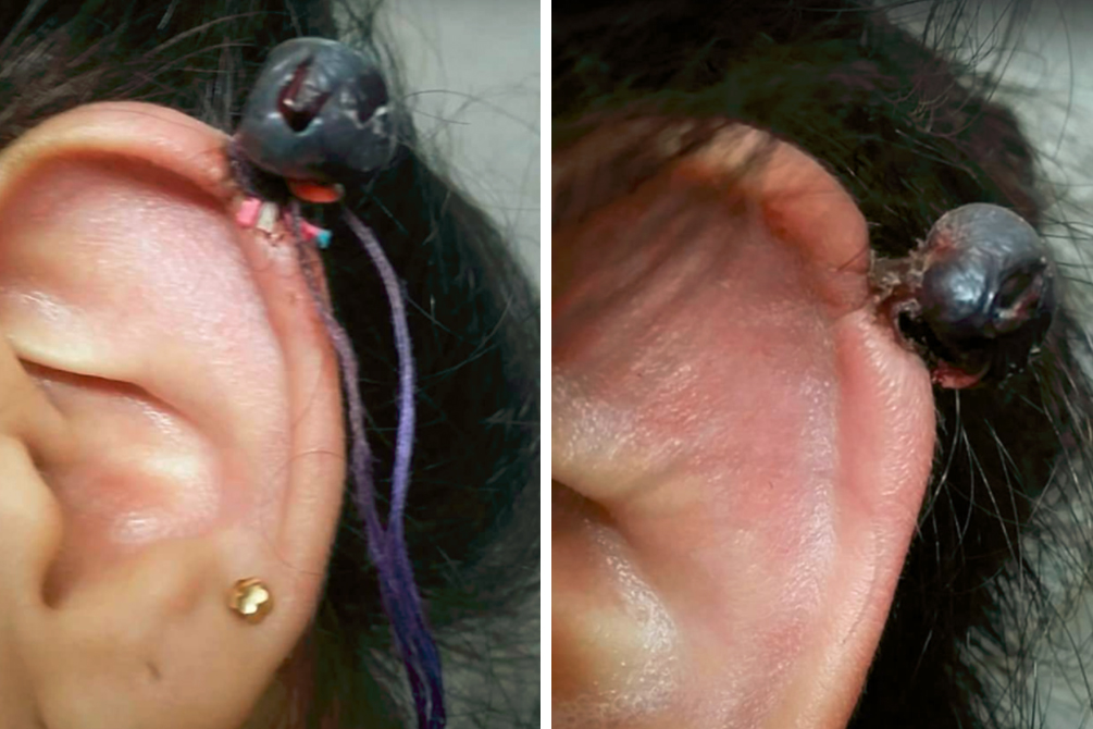 metodo-caseiro-remover-queloides-04