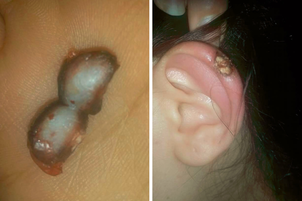 metodo-caseiro-remover-queloides-05