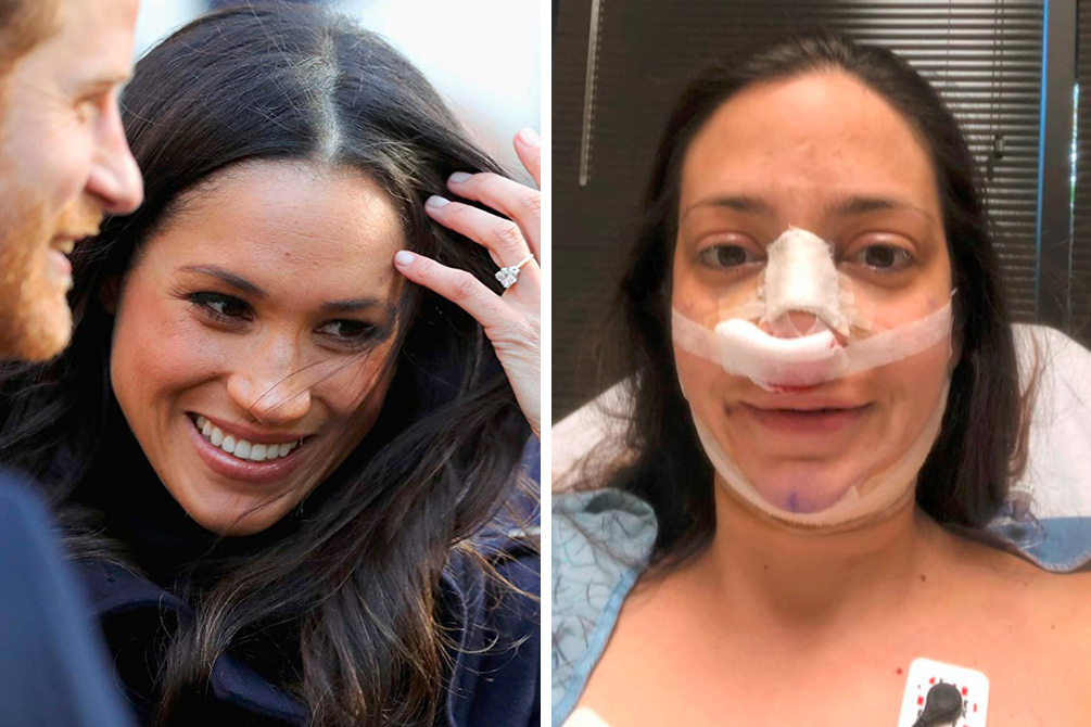 Mulher investe quase 95 000 reais para ficar parecida com Meghan Markle