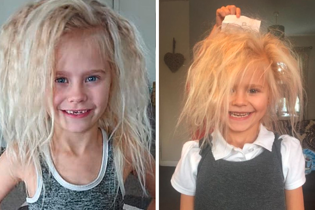 Menina de 7 anos tem cabelo “impenteável” por causa de condição raríssima