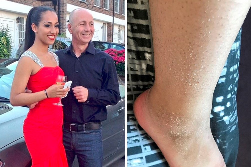 Alérgica a água, jovem não pode nem chorar: “Tentando lidar com a dor”