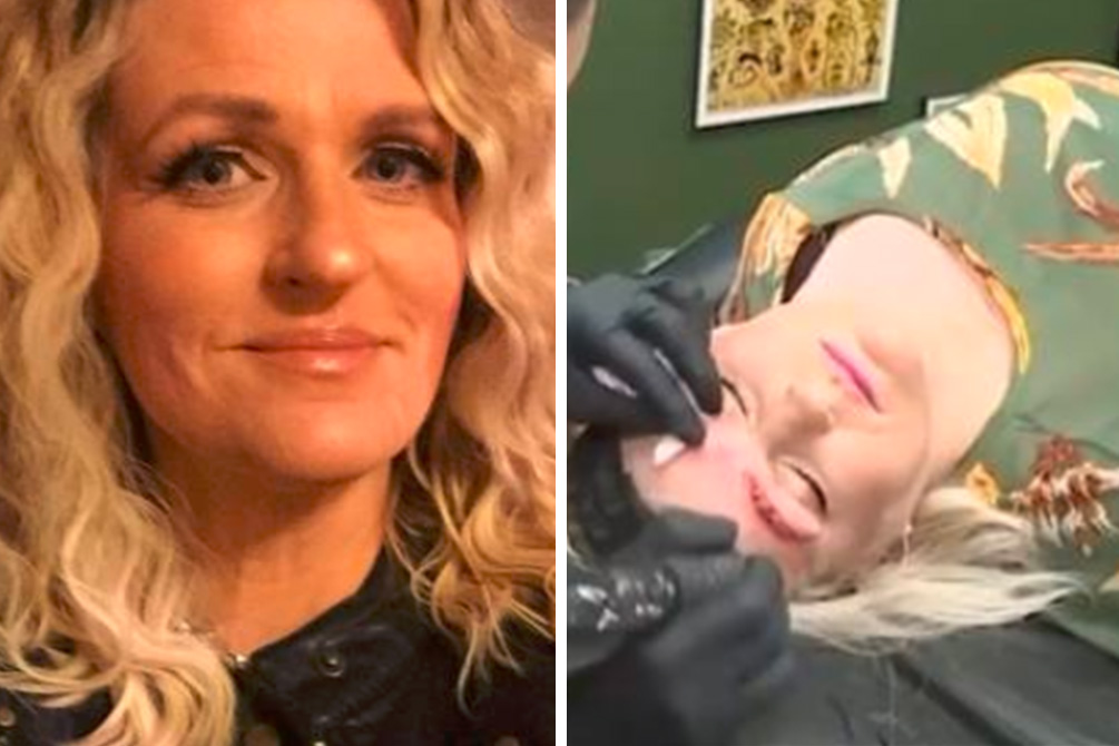 Mulher fica com “quatro sobrancelhas” após procedimento estético