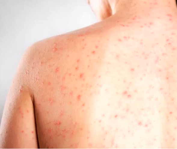 País já registra 1.680 casos de sarampo em 11 estados