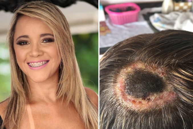 Mulher tem parte da cabeça necrosada após fazer luzes no cabelo