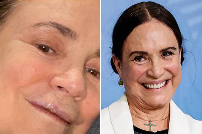 Regina Duarte tropeça em calçada, quebra três dentes e passa por cirurgia