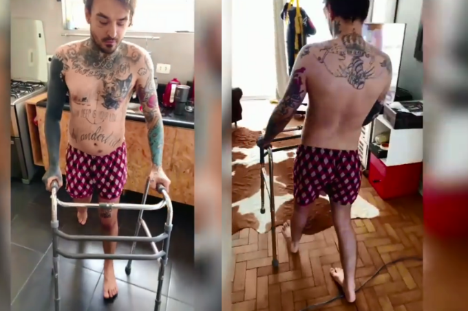 O que é osteonecrose, a doença degenerativa rara que afetou PC Siqueira