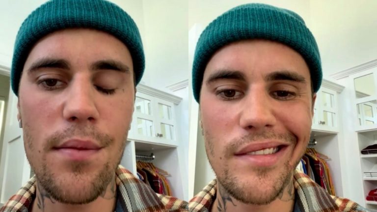 Justin Bieber faz vídeo com metade do rosto paralisado e explica motivo