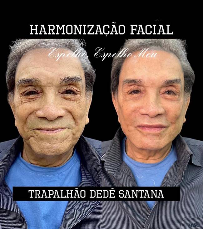 Antes e depois de harmonização facial de Dedé Santana Antes e depois de harmonização facial de Dedé Santana
