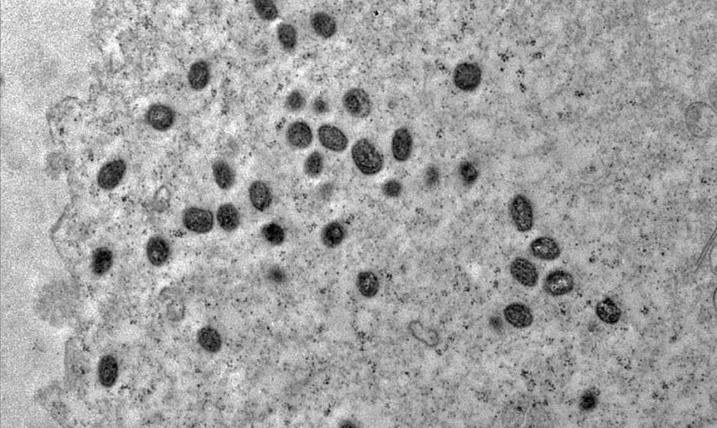 Mpox: saiba os sintomas e as formas de transmissão