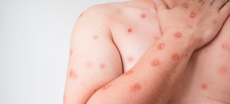 São Paulo registrou mais de 500 casos de Mpox, em 2024